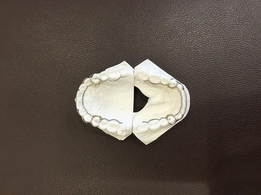 歯列矯正用ワイヤーリテーナー